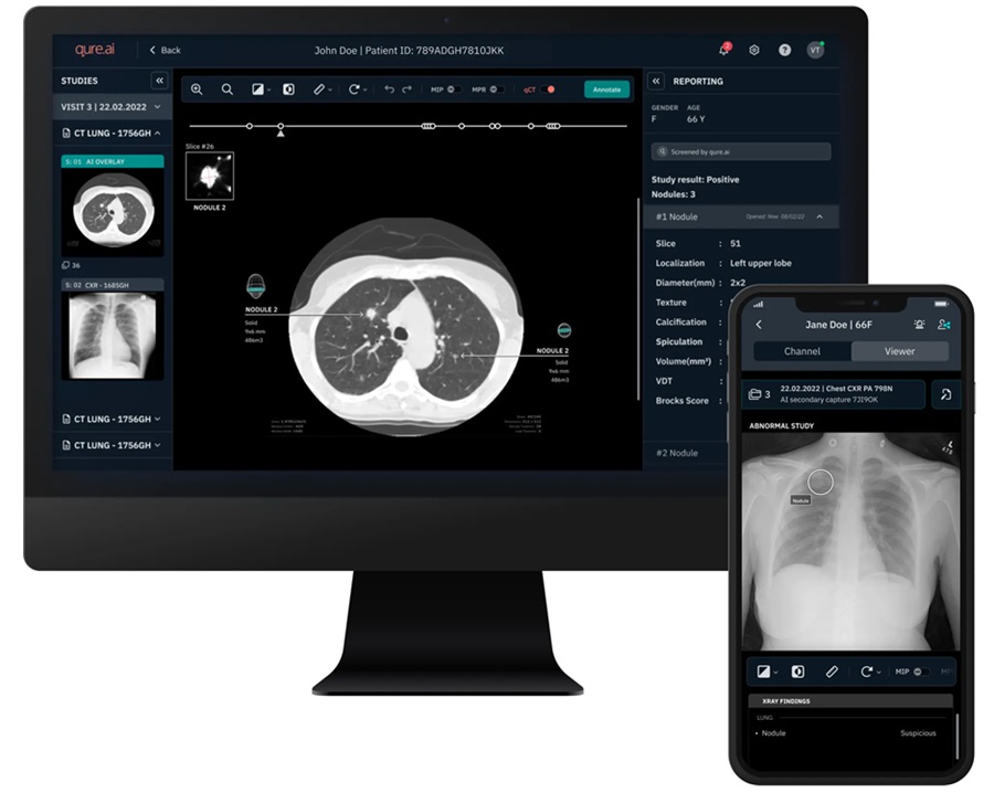 Imagen: El estudio demostró que la solución de IA de rayos X de tórax qXR puede detectar nódulos pulmonares mucho antes de que aparezcan los síntomas (foto cortesía de Qure.ai)